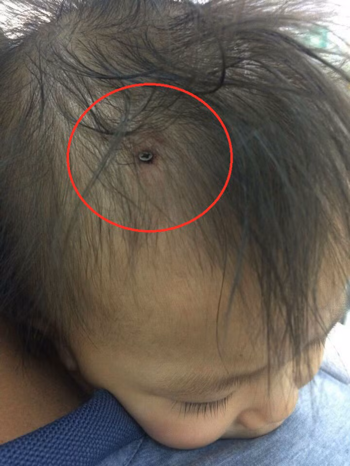 Be gai 19 thang bi dong dinh vit vao dau