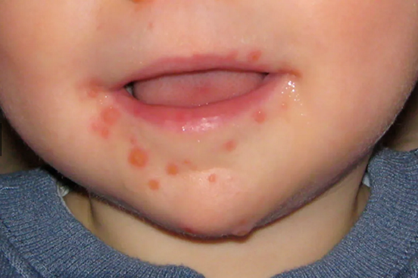 Tre mac tay chan mieng: An gi mau khoi benh?-Hinh-2