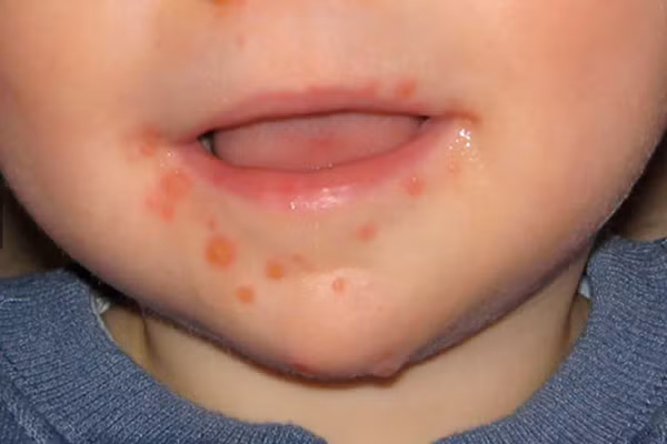 Trẻ mắc tay chân miệng: Ăn gì mau khỏi bệnh? - Hình 2 Tre mac tay chan mieng: An gi mau khoi benh?-Hinh-2