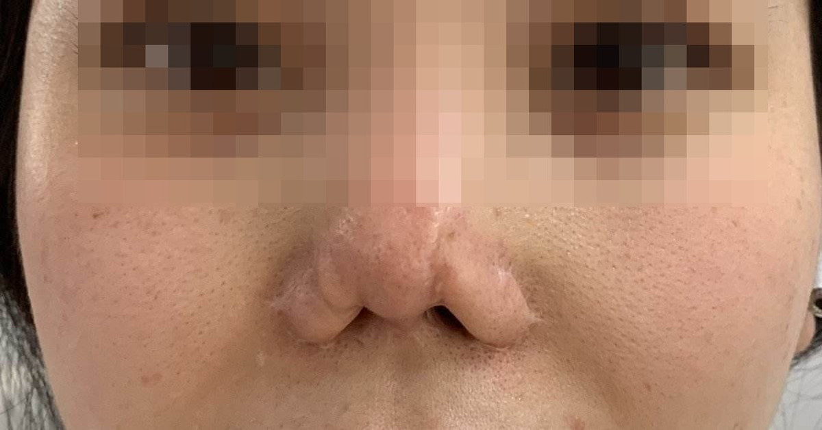 Tu vong khi nang nguc va loat tai nan phau thuat tham my-Hinh-2