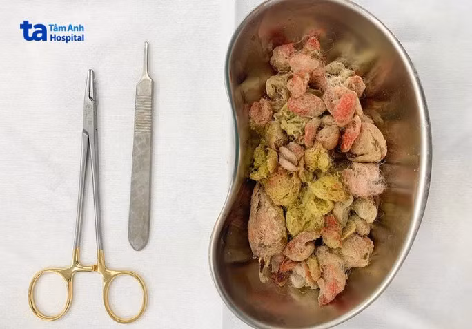 Tre nguy kich vi an ruot gau bong: Bac si khuyen cao gi?