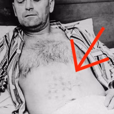 Sau đó, ông Michalak cảm thấy đau nhức ở ngực và khi nhìn xuống thấy bị bỏng khá nặng. Vì vậy, ông được đưa đến bệnh viện ở Winnipeg điều trị vết bỏng ở ngực và tay.