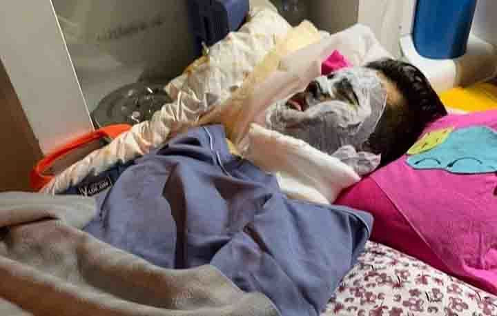 Vụ tạt axit kinh hoàng ấy không chỉ trở thành nỗi ám ảnh, khắc sâu vào tâm trí của anh Nghiêm mà nó còn mang theo nỗi đau thể xác dai dẳng với hàng chục cuộc phẫu thuật lớn nhỏ để tìm lại ánh sáng và xóa đi những vết sẹo trên gương mặt và cơ thể sau khi bị axit tàn phá. 