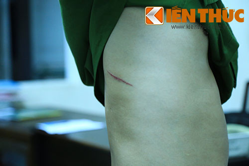 Vết thương trên người trung uý Thông do bị nữ quái dùng dao đâm.