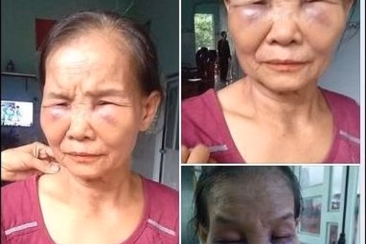 Sáng hôm sau, do quá đau nên bà Tạo nhờ người điện cho các con đến. Lúc này, các con bà Tạo tá hỏa biết sự việc và không khỏi căm phẫn khi nhìn thấy mẹ mình bị nàng dâu bạo hành nên đến trình báo công an, đồng thời chụp ảnh đăng tải lên mạng xã hội. Sáng 3/7, tại cơ quan công an, chị Tr. đã xin lỗi mẹ chồng và viết bản cam kết không tái phạm. Bà Tạo cũng nhận thấy mình có một phần lỗi nhưng chưa chấp nhận cho con dâu về lại nhà ở chung.