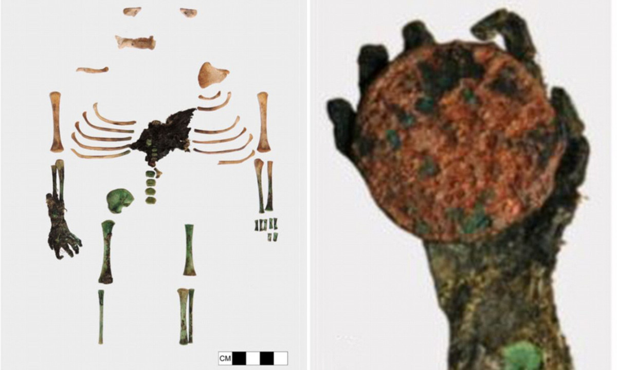 Sau nhiều năm, đồng xu làm bằng đồng bị oxy hóa khiến bàn tay và nhiều phần cơ thể của đứa trẻ có màu xanh.