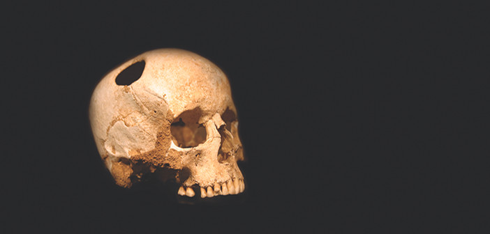 Người xưa làm phẫu thuật này để chữa trị cơn đau đầu cho bệnh nhân. Do phẫu thuật mở hộp sọ khá nguy hiểm nên bệnh nhân có thể tử vong trong ca phẫu thuật hoặc sau đó.