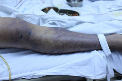 Mot nguoi tu vong do an tiet canh nhiem lien cau lon-Hinh-2