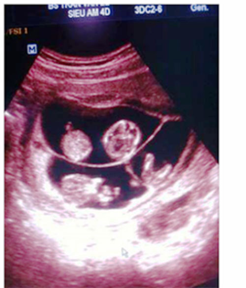 Mot phu nu o Quang Binh mang thai bon hiem gap-Hinh-2