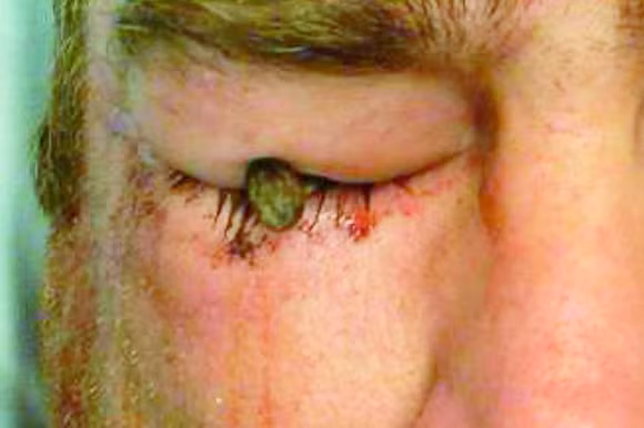 Bi cay dinh dai 7cm dam vao mat van nhin binh thuong