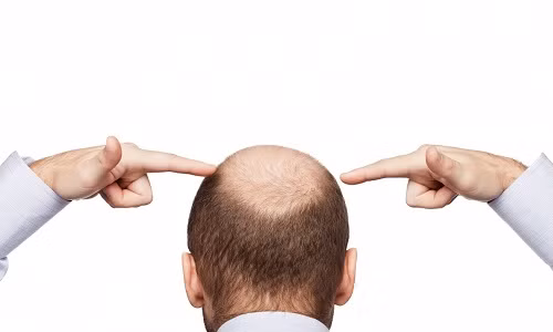 Có nhiều cách ngăn ngừa rụng tóc cho nam giới.