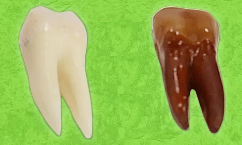 Răng bị ố vàng và mài mòn khi uống nước ngọt.