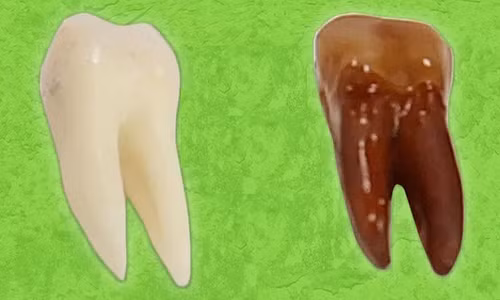 Răng bị ố vàng và mài mòn khi uống nước ngọt.