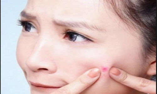 Mụn là kẻ thù của rất nhiều người.