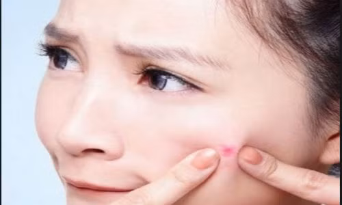 Mụn là kẻ thù của rất nhiều người.