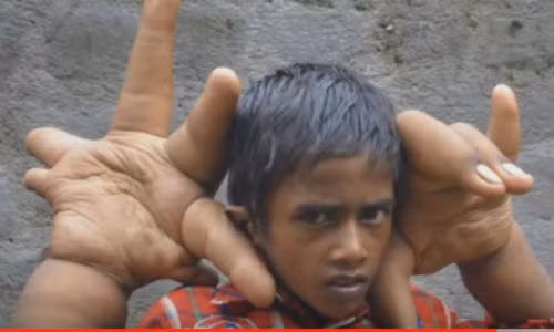 Người đàn ông có bàn tay kì dị.