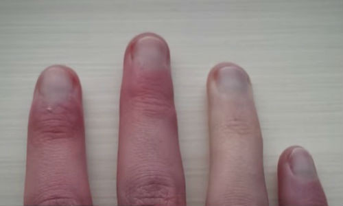 Chúng ta có thể nhận biết bệnh tật qua móng tay.