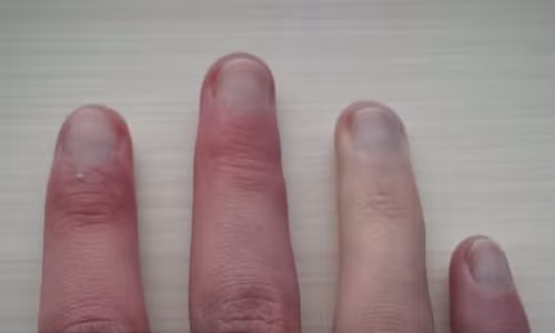 Chúng ta có thể nhận biết bệnh tật qua móng tay.