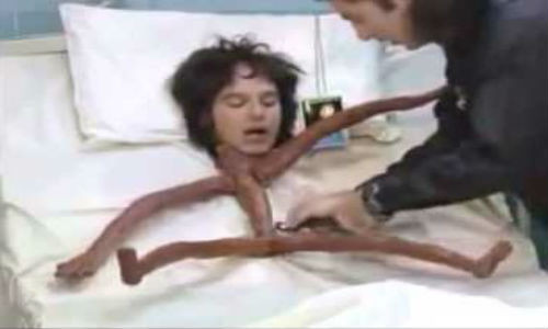 Người đàn ông gầy nhất thế giới.