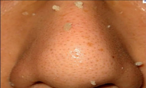 Mụn đầu đen là "kẻ thù" của nhiều người.