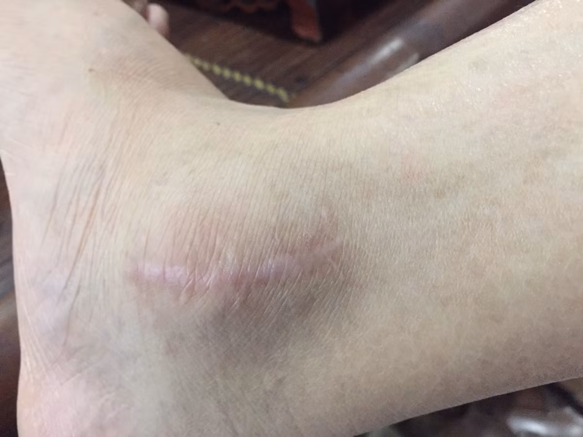 Gần 2 năm bị nhóm Tiến “Trắng” vô cớ đánh nát chân (phần mắt cá), anh Nguyễn Mạnh Hùng (33 tuổi, ở huyện Vũ Thư) cho hay, vết thương chưa thể bình phục. Trong thời gian tới, anh sẽ phải thực hiện hai lần phẫu thuật khác.