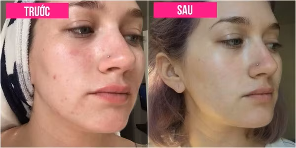 Ngày 7: Samantha chia sẻ, da cô không hoàn hảo nhưng nó đã không còn sưng đỏ nữa. Những đốm đỏ do mụn đã nhạt màu hơn, những đốm mụn bớt sưng hơn. Cô nghĩ rằng cô sẽ thường xuyên nhìn vào những bức ảnh này để nhắc nhở mình không đưa tay lên mặt, bất kể là việc đó có "cám dỗ" như thế nào.