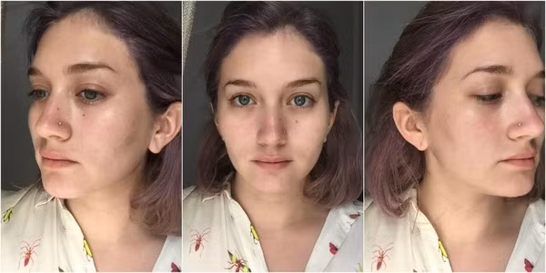 Ngày thứ 6: Da của Samantha vẫn còn tồn tại một vài nốt mụn, nhưng đã mờ hơn nhiều so với ngày thứ nhất.