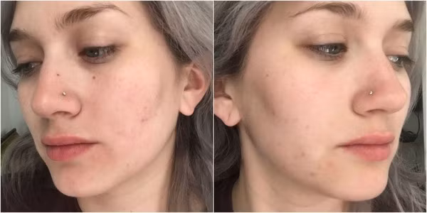 Ngày 4: Samantha cho hay, da cô đã bắt đầu khá hơn, mặc dù vẫn còn vài đốm mụn nhỏ. Ngày 5: Da của Samantha trông đã đẹp hơn hẳn, mỗi ngày cô chỉ dùng một chút serum dưỡng ẩm thay vì kem nền. Cô cho rằng, rõ ràng thí nghiệm này cực kỳ có ích. Bởi trước đó, biên tập viên làm đẹp này luôn cho rằng nếu cô không nặn mụn, da cô sẽ càng có nhiều mụn hơn trong khi kết quả thử nghiệm đã mang lại hiệu quả hoàn toàn khác.