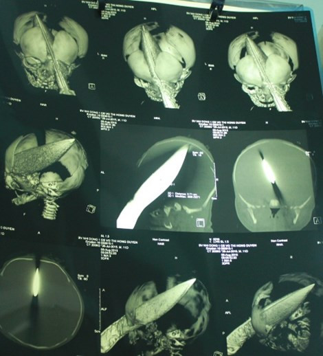 Be trai 11 ngay tuoi bi dam xuyen so ngay tai benh vien