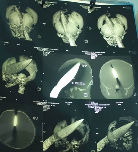 Be trai 11 ngay tuoi bi dam xuyen so ngay tai benh vien