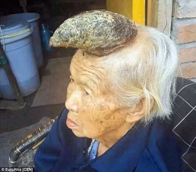 Xôn xao cụ bà 87 tuổi mọc sừng trên đầu dài 13 cm Xon xao cu ba 87 tuoi moc sung tren dau dai 13 cm