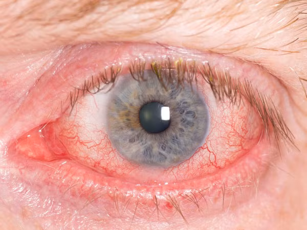 Dùng thuốc nhỏ mắt. Khi mắt bị kích ứng nhẹ, bác sĩ khuyên bạn nên sử dụng thuốc nhỏ, nước muối nồng độ thấp để rửa. Bạn không nên tự ý sử dụng thuốc để điều trị khi chưa có chỉ dẫn của bác sĩ.