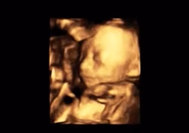 Hình ảnh siêu âm 1 tháng trước khi sinh, bé Jaycie hoàn toàn khỏe mạnh và gần như đã sẵn sàng để chào đời.