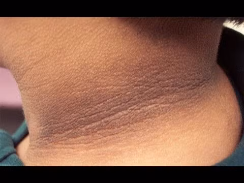 Vòng đen dưới cổ. Đây có thể là dấu hiệu cảnh báo nguy cơ cao bạn mắc tiểu đường type 2.