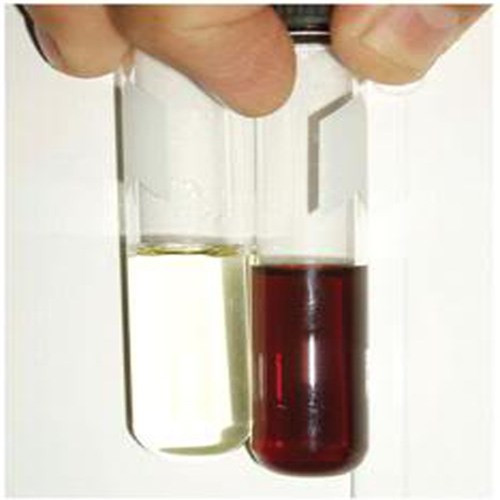 Máu trong nước tiểu có thể là dấu hiệu của ung thư bàng quang. Tiểu ra máu về cuối bãi và thường bất ngờ người bệnh ung thư bàng quang. Mọi triệu chứng tiểu ra máu đi kèm với mệt mỏi, đau rát đều phải nghĩ ngay tới ung thư bàng quang và cần phải đi khám ngay và thực hiện các xét nghiệm cận lâm sàng cần thiết để khẳng định chẩn đoán.