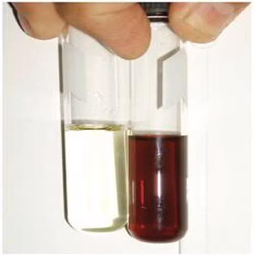 Máu trong nước tiểu có thể là dấu hiệu của ung thư bàng quang. Tiểu ra máu về cuối bãi và thường bất ngờ người bệnh ung thư bàng quang. Mọi triệu chứng tiểu ra máu đi kèm với mệt mỏi, đau rát đều phải nghĩ ngay tới ung thư bàng quang và cần phải đi khám ngay và thực hiện các xét nghiệm cận lâm sàng cần thiết để khẳng định chẩn đoán.