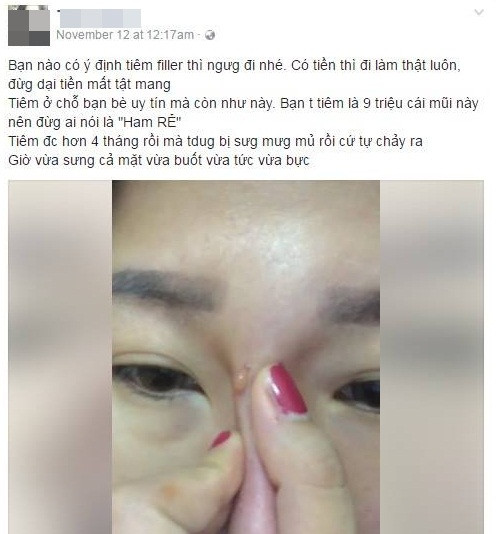 Nhận trái đắng từ trào lưu nâng mũi bằng tiêm filler - Hình 2 Nhan trai dang tu trao luu nang mui bang tiem filler-Hinh-2