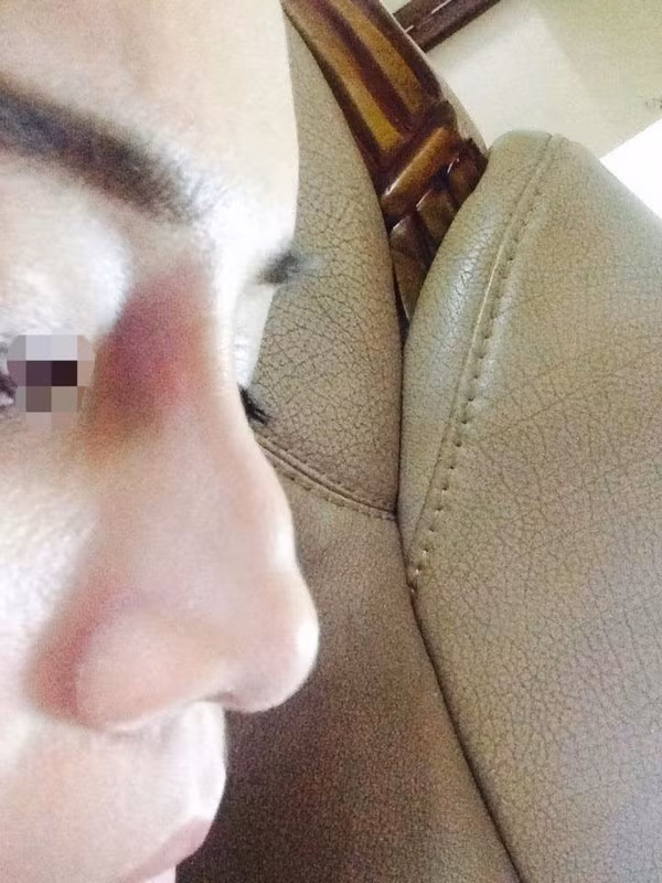 Hotgirl bi chay dich mu sau tiem filler nang mui-Hinh-4