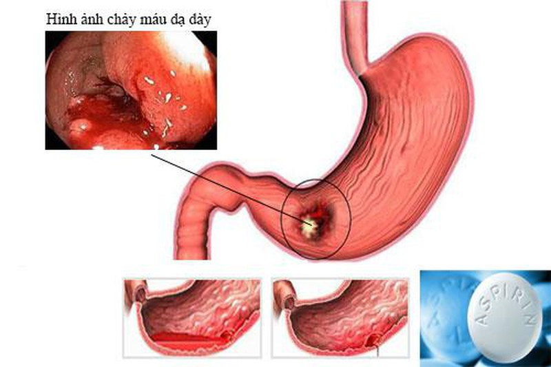 Nhung loai thuoc ha sot khong duoc dung khi sot xuat huyet