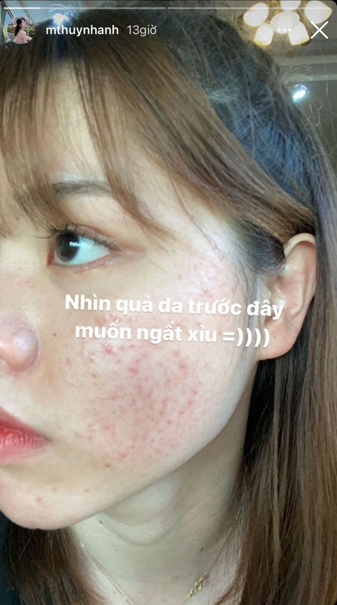 Thế nhưng mới đây, Huỳnh Anh lại khiến nhiều người sửng sốt khi đăng tải hình ảnh gương mặt kém xinh với làn da chi chít mụn đỏ của mình trước đây.