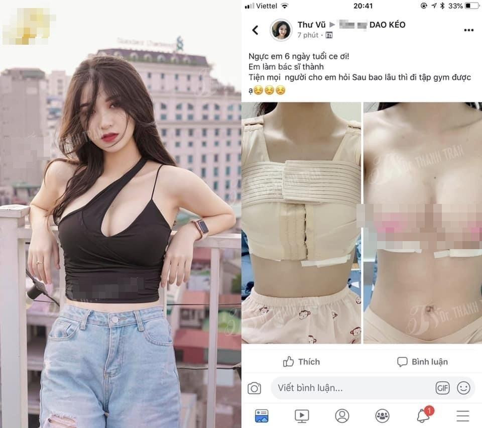 Hình ảnh sau 6 ngày làm ngực được Anh Thư từng đăng tải trong group có tiếng về dao kéo đã bị cư dân mạng tìm lại.