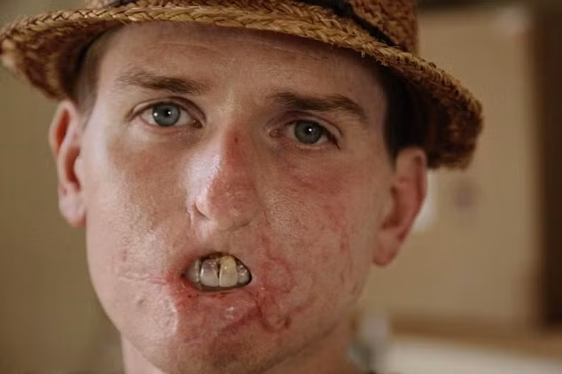 Sau tai nạn, con trai của Alex Lewis không nhận ra cha mình. Anh cũng không còn đôi chân để trở thành bạn chơi bóng với con trai. Con trai anh thậm chí không muốn hôn cha. Điều này làm anh vô cùng đau khổ vì điều này. 