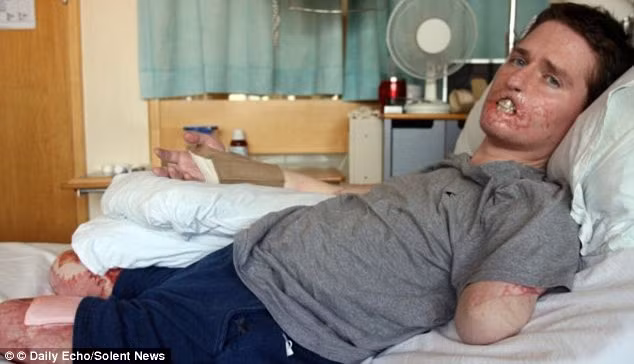  Vi khuẩn ăn thịt người khiến Alex Lewis (35 tuổi - người Anh) bị biến dạng khuôn mặt và mất đi một phần cơ thể. Khi trong tình trạng nguy kịch, anh giành giật lấy 3% cơ hội sống sót để phục hồi và trở lại cuộc sống. 