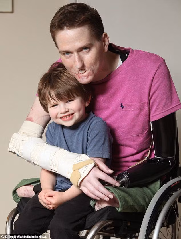 Các bác sĩ cũng nỗ lực hết sức để tái tạo lại khuôn mặt cho Lewis. Ngoài ra, các bác sĩ còn lấy da ở vai để tái tạo môi cho Lewis.