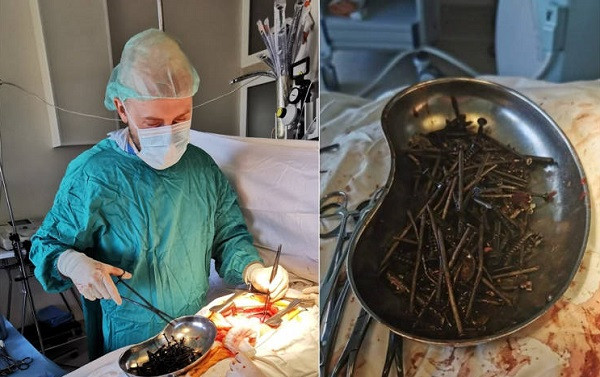 Choang: Nguoi dan ong nuot 1kg dinh vit vao bung!-Hinh-2