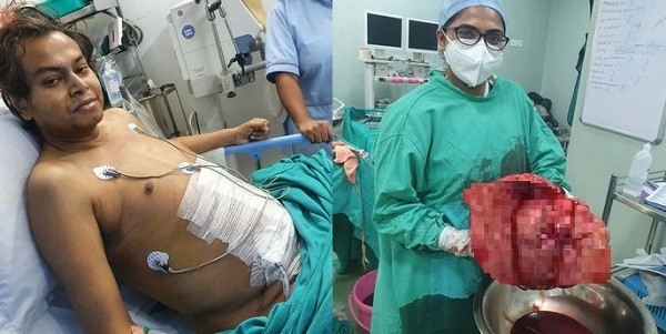 Kinh hai khoi u khong lo khien nguoi dan ong nhu dang mang bau