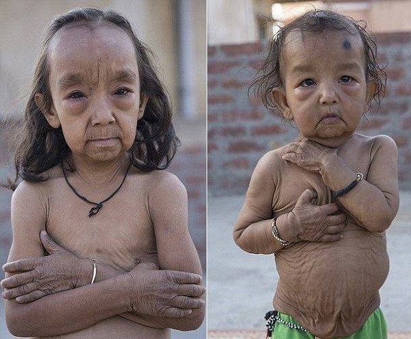 Be gai mang khuon mat gia hon cha me vi nguyen nhan dau long