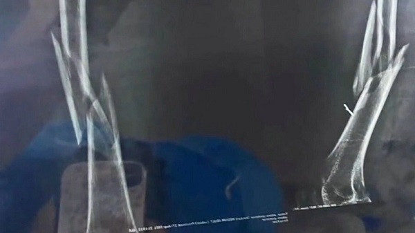 Giao vien yoga be gay xuong dui cua hoc vien trong luc day-Hinh-2