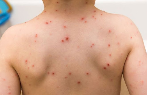 Một trong những bệnh thường gặp, phổ biến trong thời tiết nắng nóng chính là các bệnh truyền nhiễm. Đây là thời gian có điều kiện môi trường rất thuận lợi cho các loại siêu vi phát triển. Ảnh: googleusercontent.