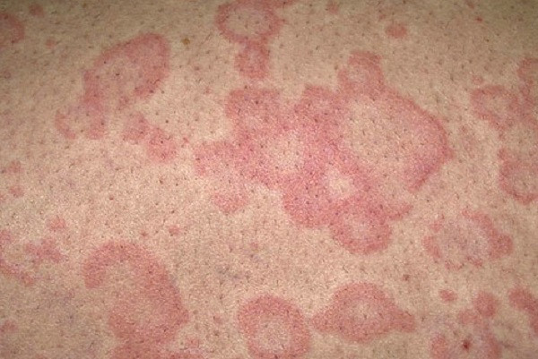 Lý do là vì trời nắng nóng khiến tuyến mồ hôi và tuyến nhầy tăng cường hoạt động để thải nhiệt cho cơ thể, gây ra tình trạng ẩm ướt tại các vùng như lưng, trán, cổ, kẽ tay, chân và bẹn. Ảnh: medihub.